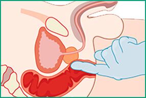 Prostat masajı - prostatit tedavisi