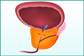 Prostatın büyümesi ve üretranın sıkışması