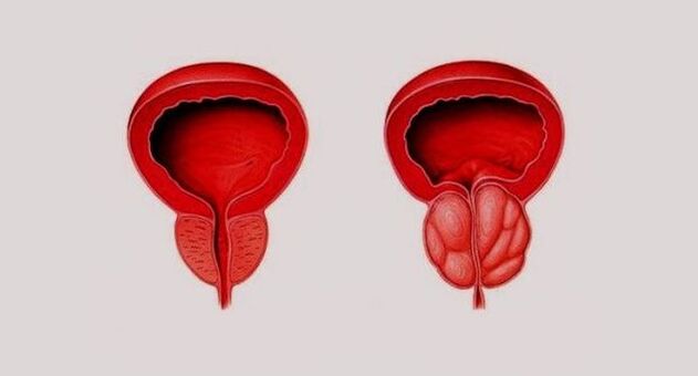 Sağlıklı prostat (solda) ve prostatite bağlı iltihaplı (sağda)