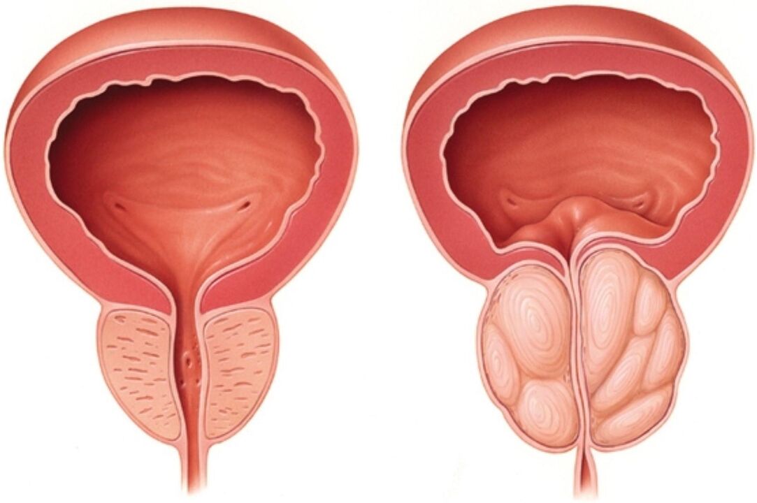 Normal prostat (solda) ve prostatitte iltihap belirtileri olan (sağda)