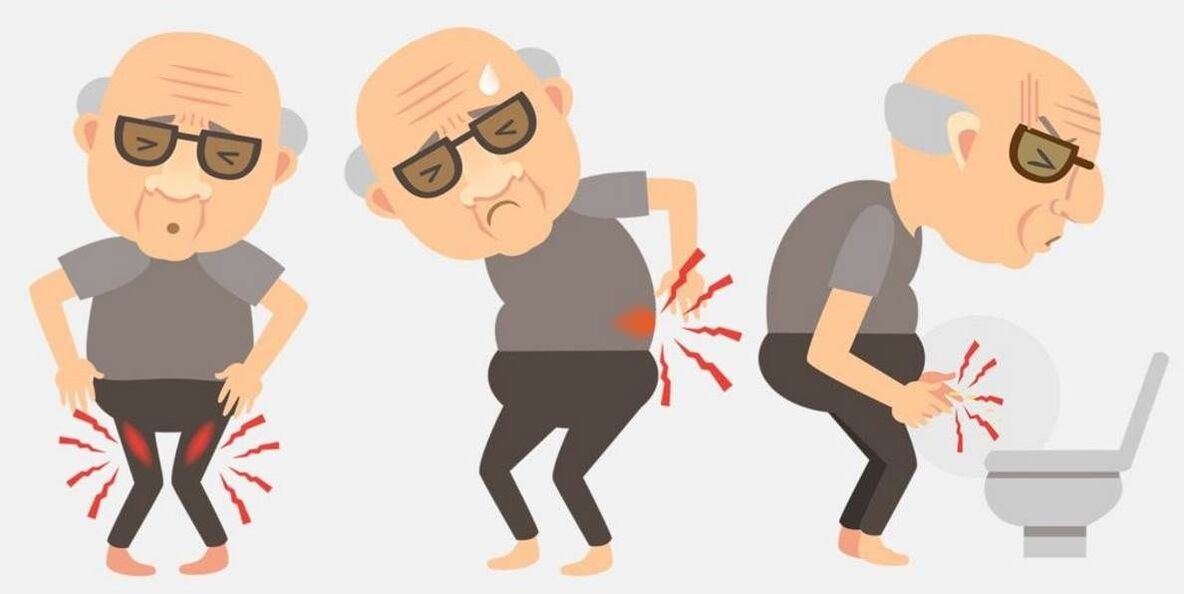 prostatit belirtileri