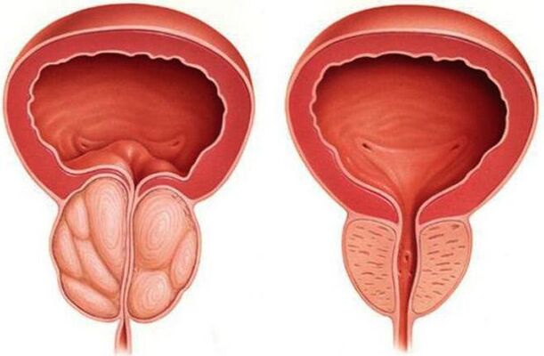 prostatit ile sağlıklı ve iltihaplı prostat